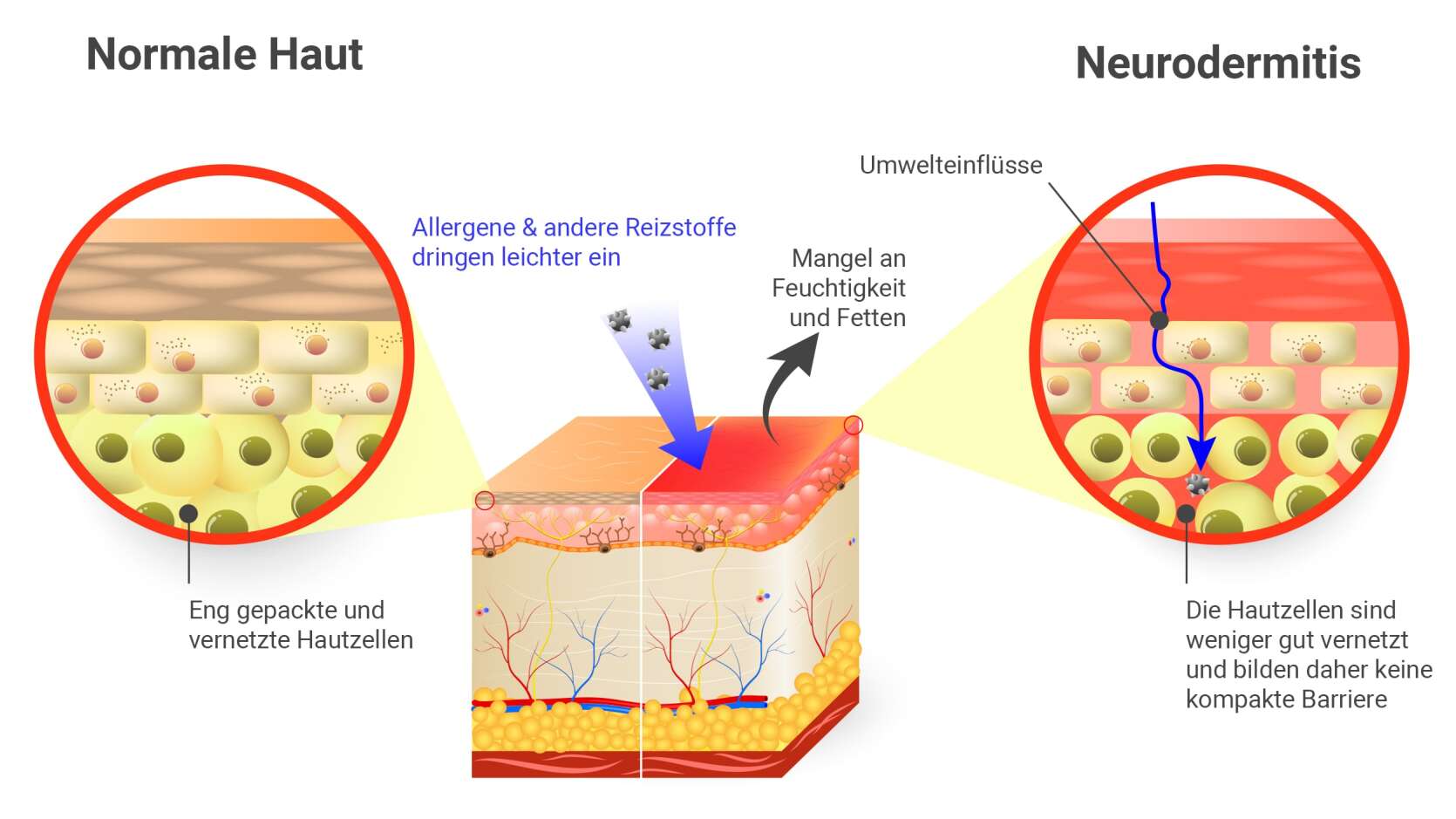 Atopisches Ekzem (Neurodermitis) Ursachen im Überblick HautRatgeber