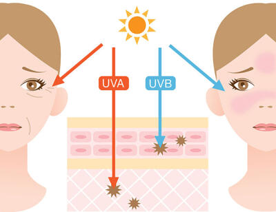 Sonnenbrand Symptome: UV-A Licht